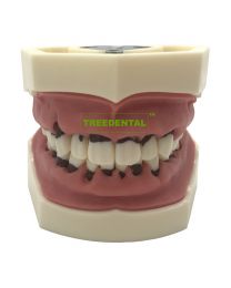 Dental Typodont Teeth Model Pathological Periodontal disease